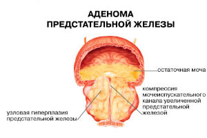 Простатэктомия (удаление предстательной железы)